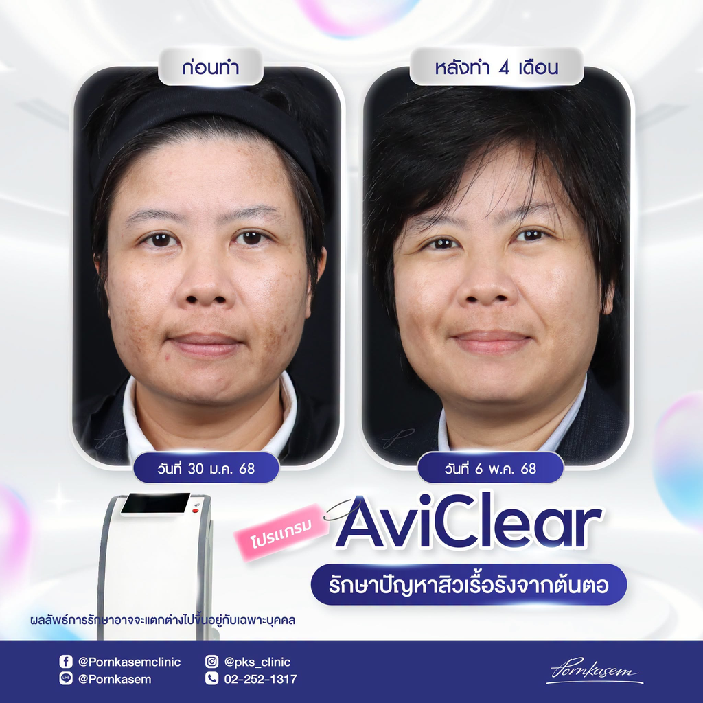 รีวิวรักษาสิวที่พรเกษมคลินิก