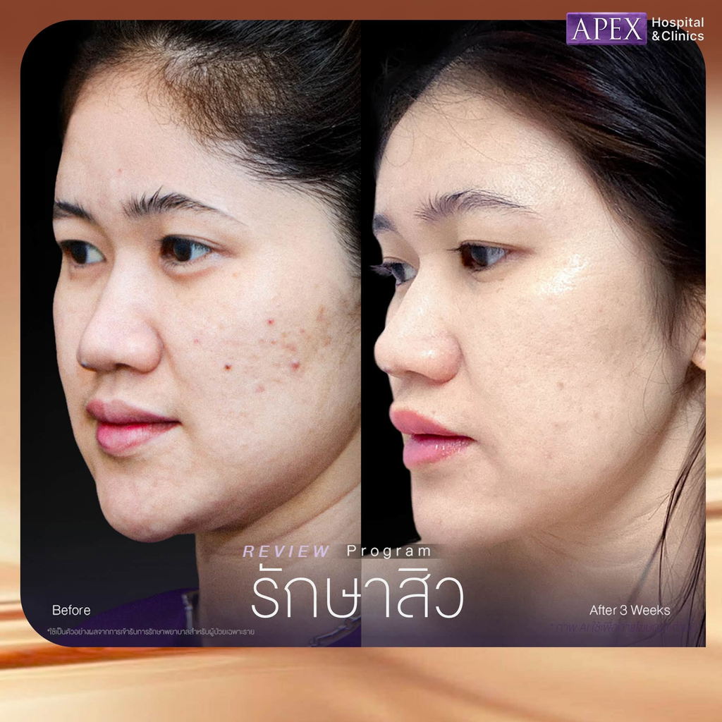 รีวิวรักษาสิวที่ Apex Profound Beauty