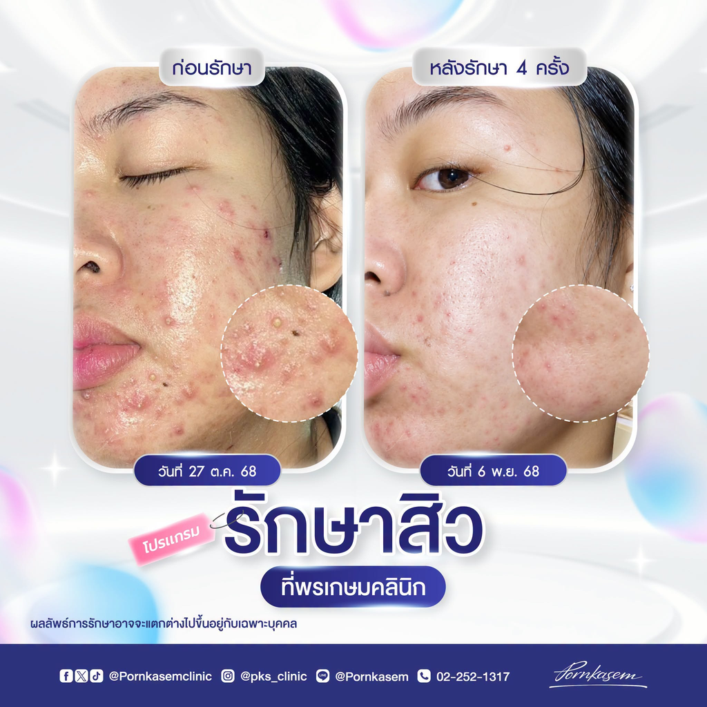 รีวิวรักษาสิวที่พรเกษมคลินิก