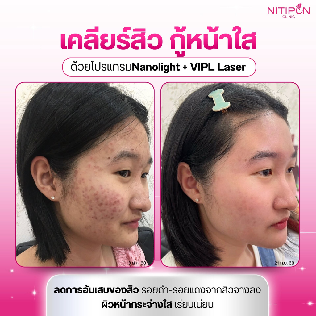 รักษาสิวที่นิติพล คลินิก
