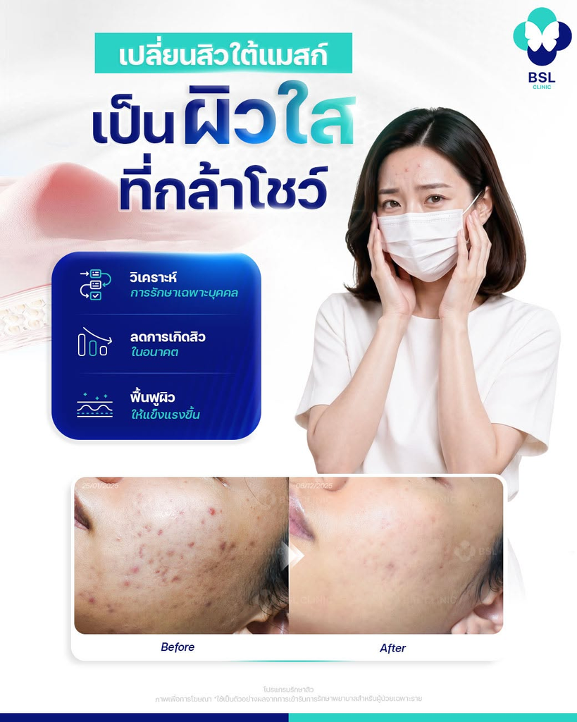 รีวิวรักษาสิวที่ BSL Clinic