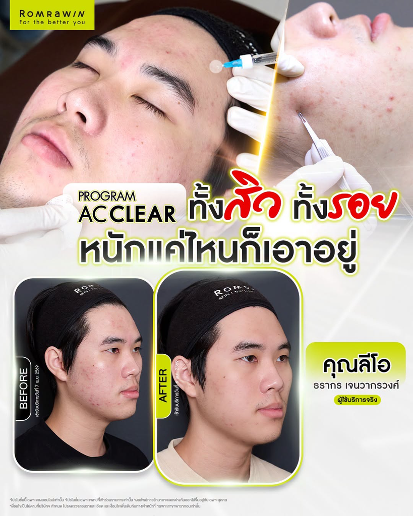 รีวิวรักษาสิวที่ Romrawin Clinic