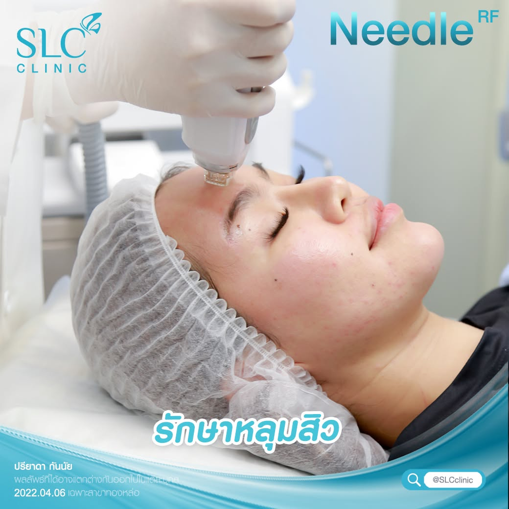 รีวิวรักษาสิวที่สยามเลเซอร์ คลินิก (SLC Clinic)