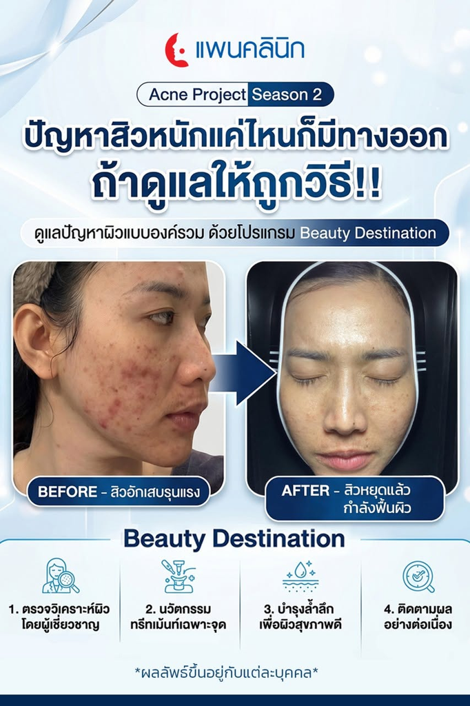 รีวิวรักษาสิวที่แพนคลินิก