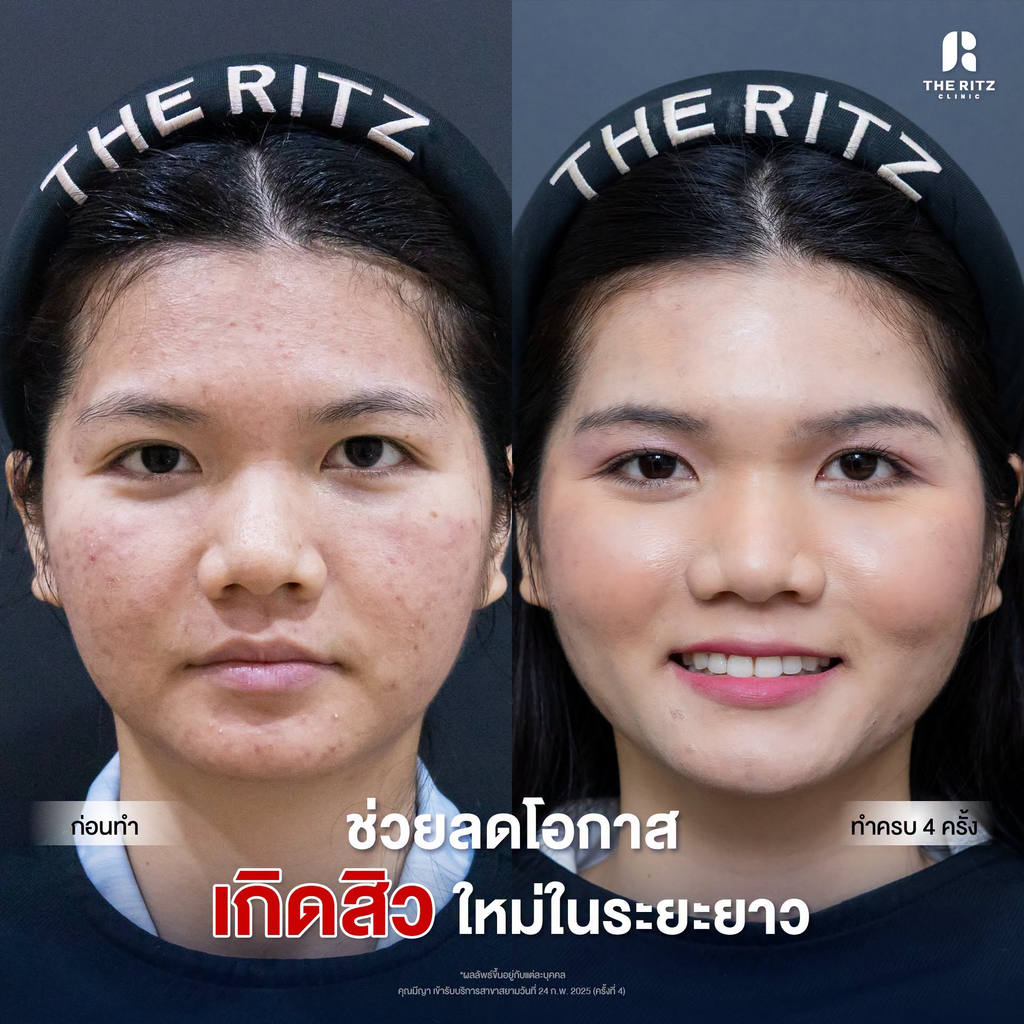 รีวิวรักษาสิวที่เดอะริทซ์ คลินิก