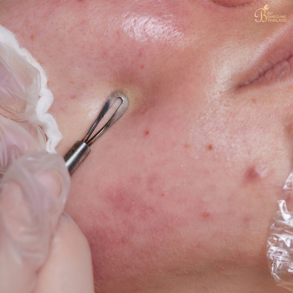 กดสิวคืออะไร