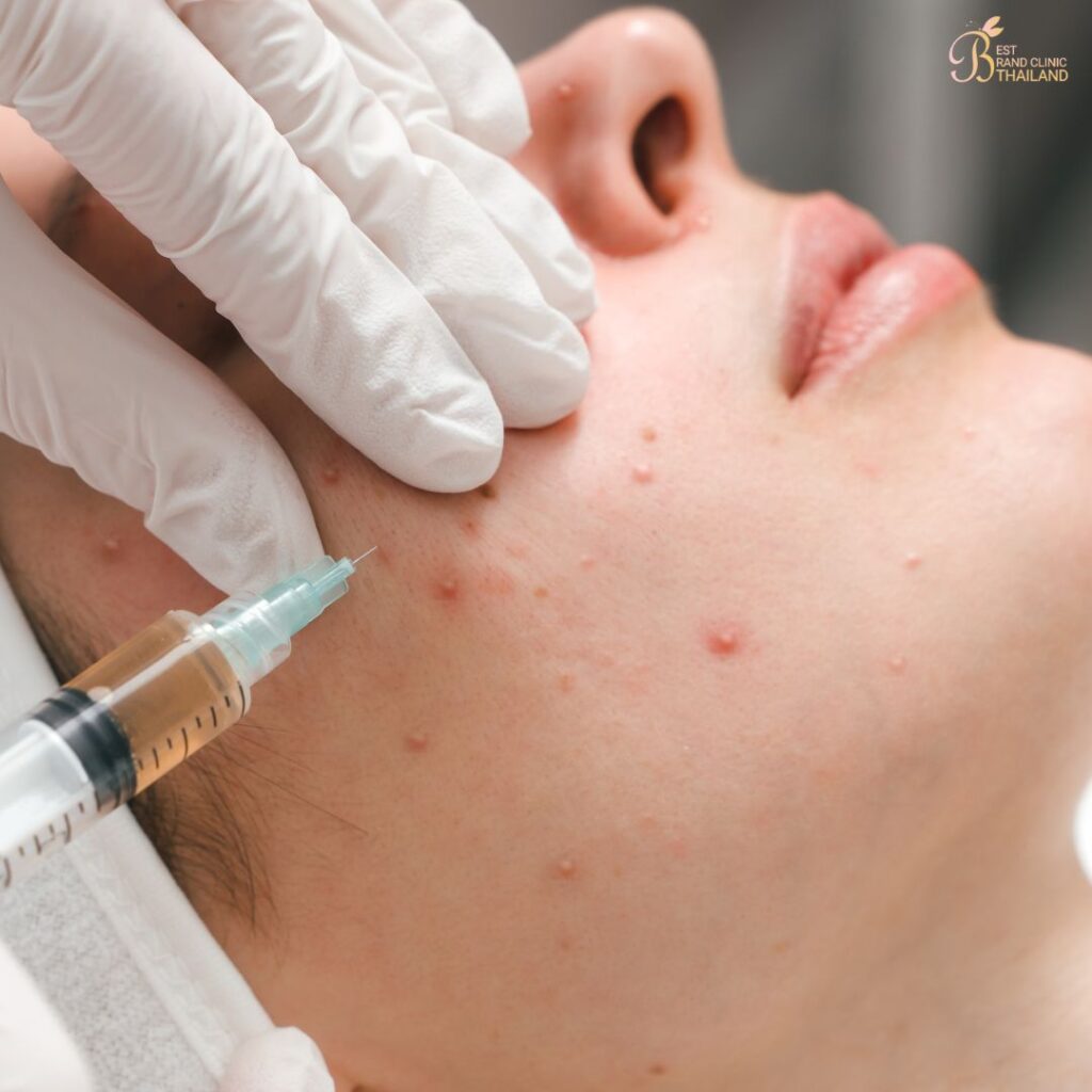 ฉีดสิวคืออะไร