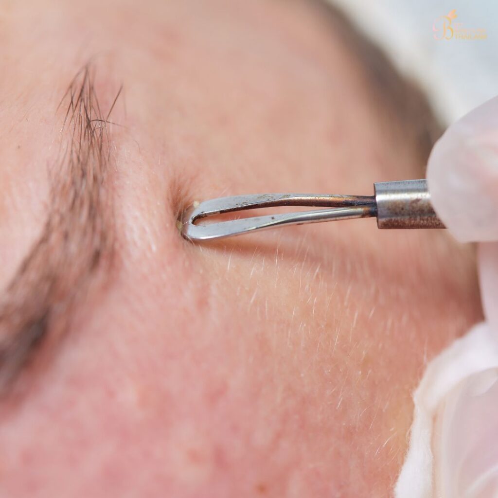 วิธีกดสิวเหมาะกับสิวแบบไหน