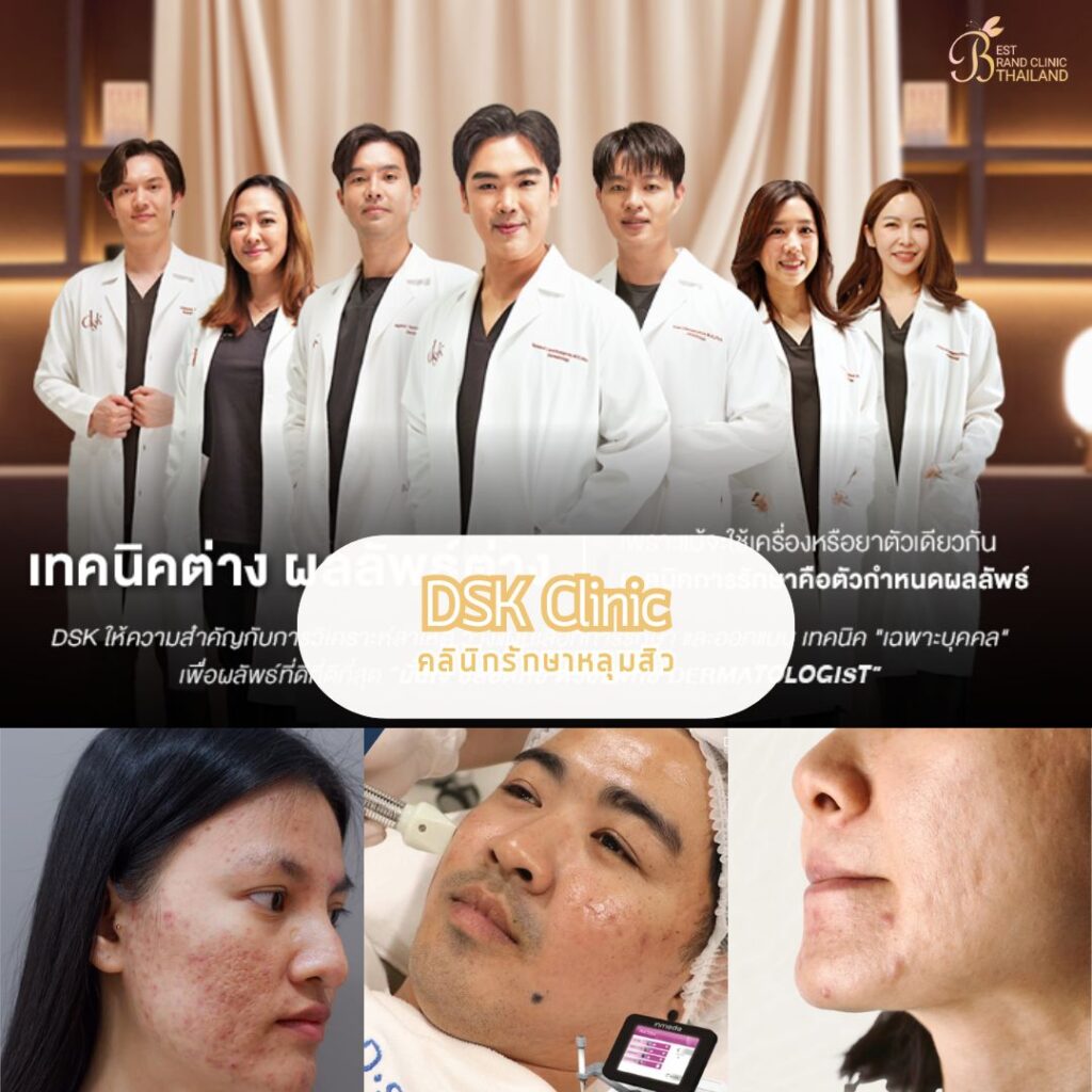 รักษาหลุมสิว ที่ DKS Clinic