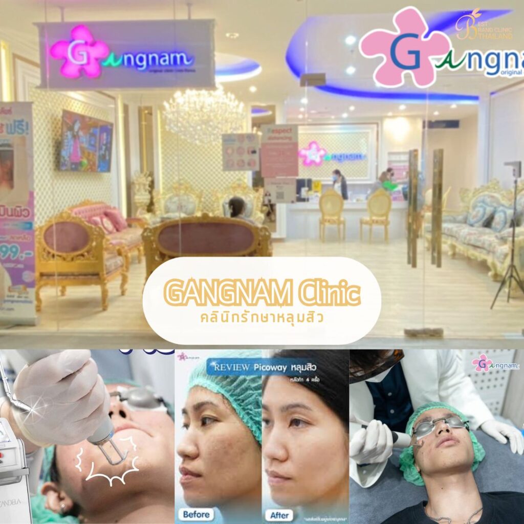 รักษาหลุมสิว ที่ Gangnam Clinic