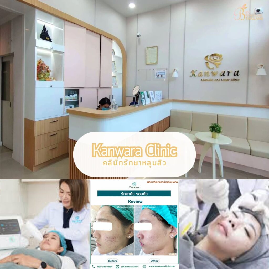 รักษาหลุมสิว ที่ Kanwara Clinic