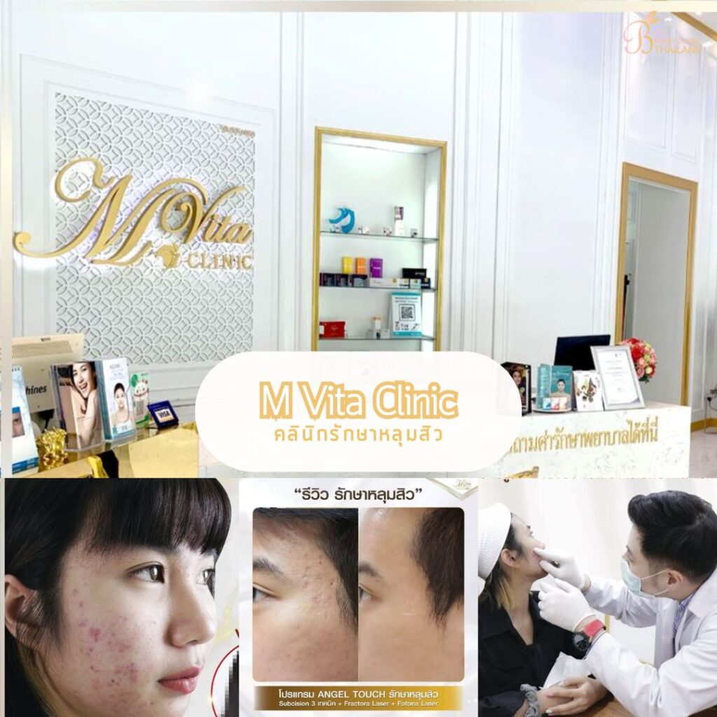 รักษาหลุมสิว ที่ M Vita Clinic
