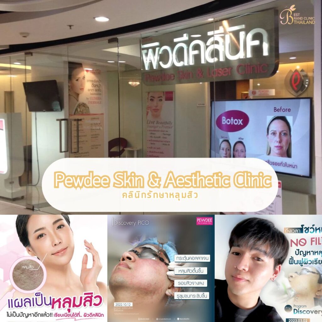รักษาหลุมสิว ที่ Pewdee Skin & Aesthetic Clinic
