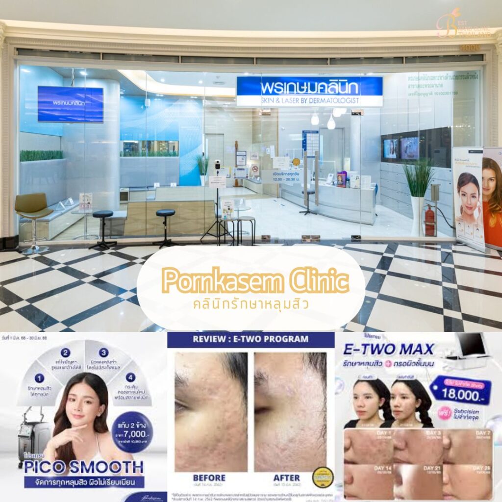 รักษาหลุมสิว ที่ Pornkasem Clinic