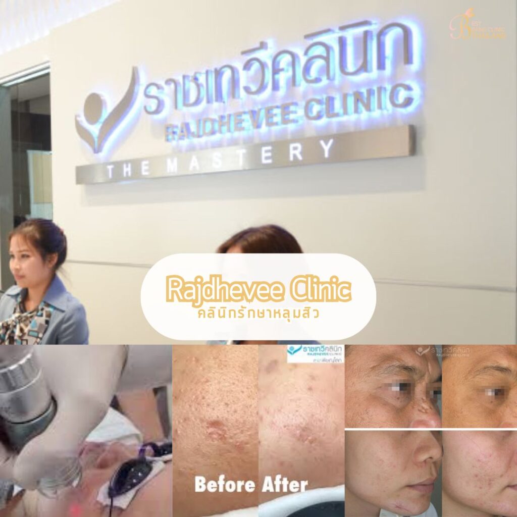 รักษาหลุมสิว ที่ Rajdhevee Clinic