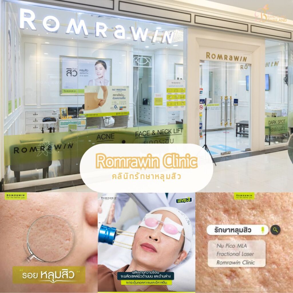 รักษาหลุมสิว ที่ Romrawin Clinic