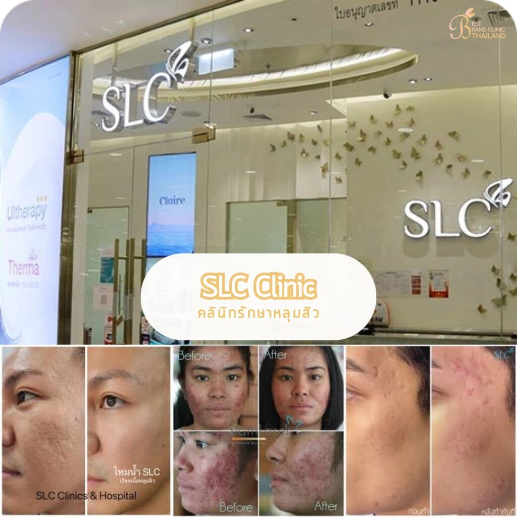 รักษาหลุมสิว ที่ SLC Clinic