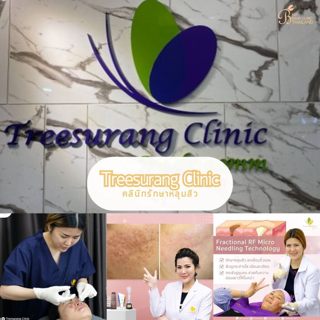 รักษาหลุมสิว ที่ Treesurang Clinic