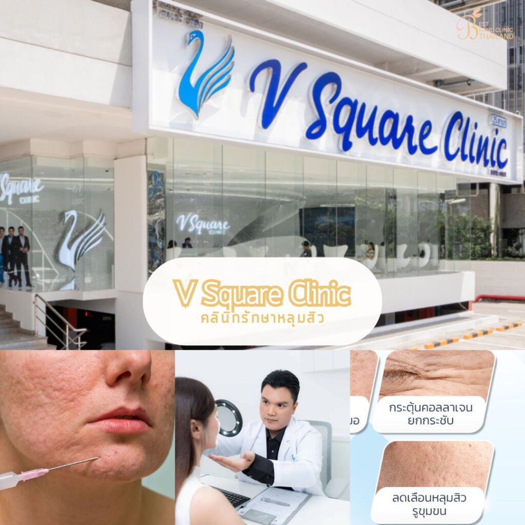 รักษาหลุมสิว ที่ V Square Clinic