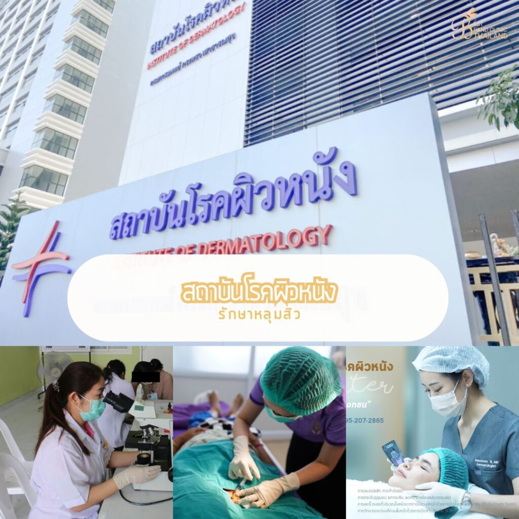 รักษาหลุมสิว ที่ สถาบันโรคผิวหนัง
