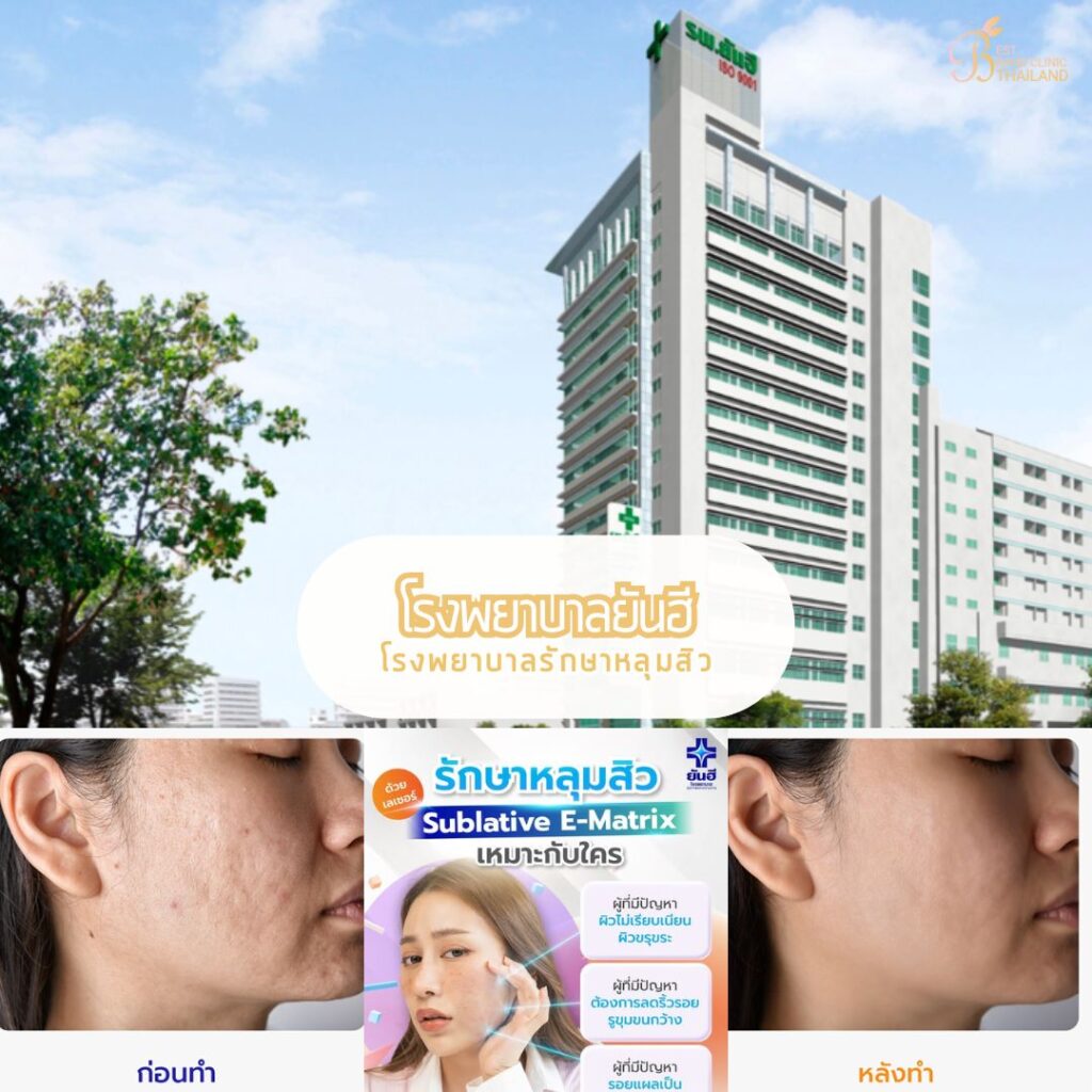 รักษาหลุมสิว ที่ โรงพยาบาลยันฮี