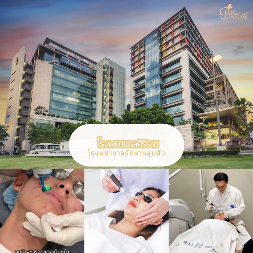 รักษาหลุมสิว ที่ โรงพยาบาลศิริราช