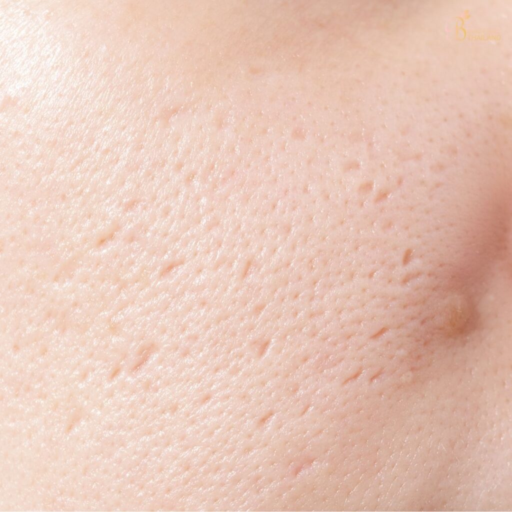 วิธีการรักษาหลุมสิวมีอะไรบ้าง