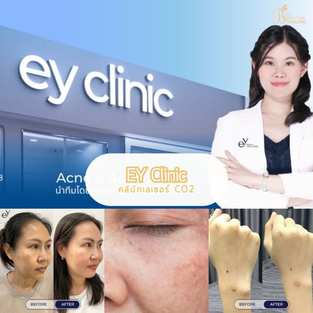 เลเซอร์ CO2 EY Clinic