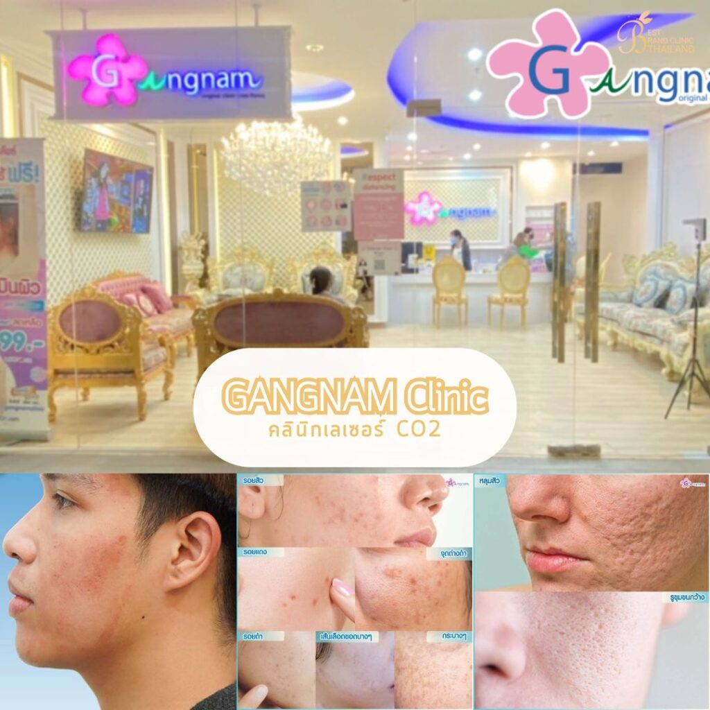 เลเซอร์ CO2 GANGNAM Clinic