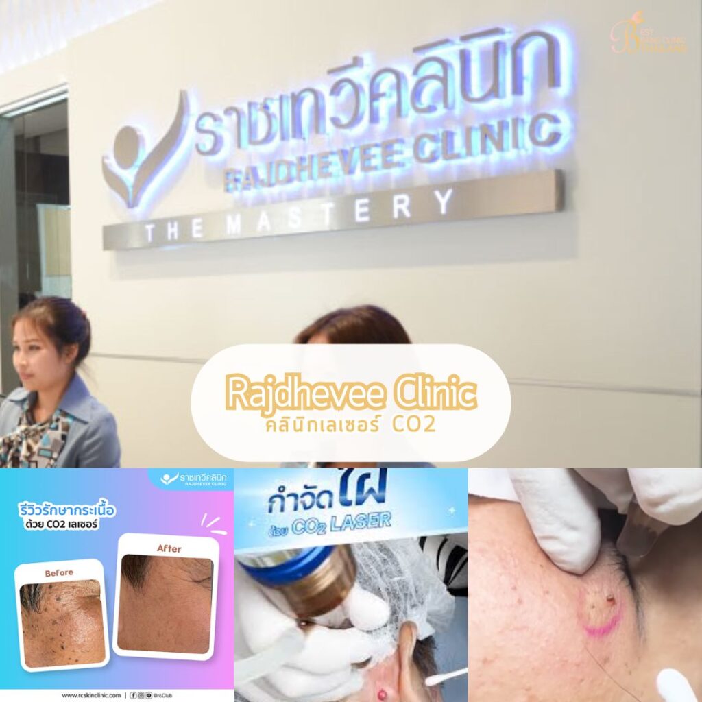 เลเซอร์ CO2 Rajdhevee Clinic