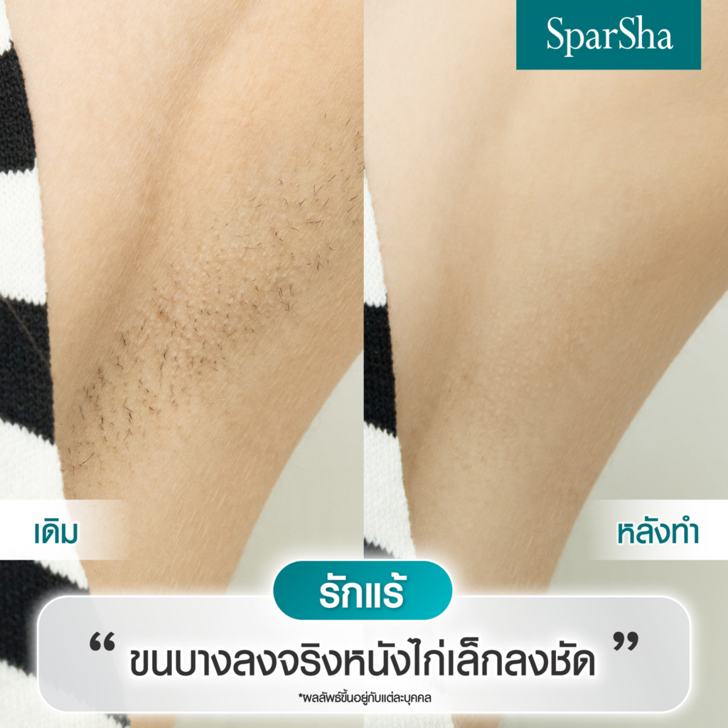 รีวิวเลเซอร์ขนที่ SparSha
