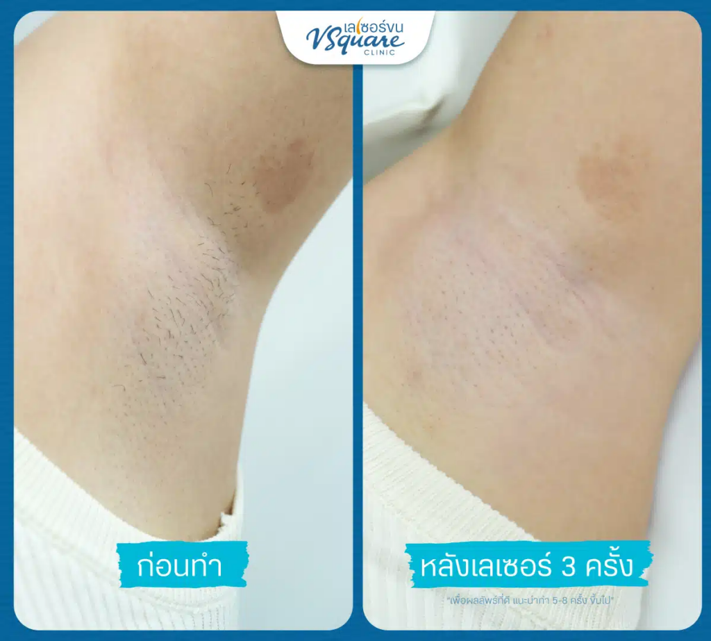 รีวิวเลเซอร์ขนที่ V Square Clinic