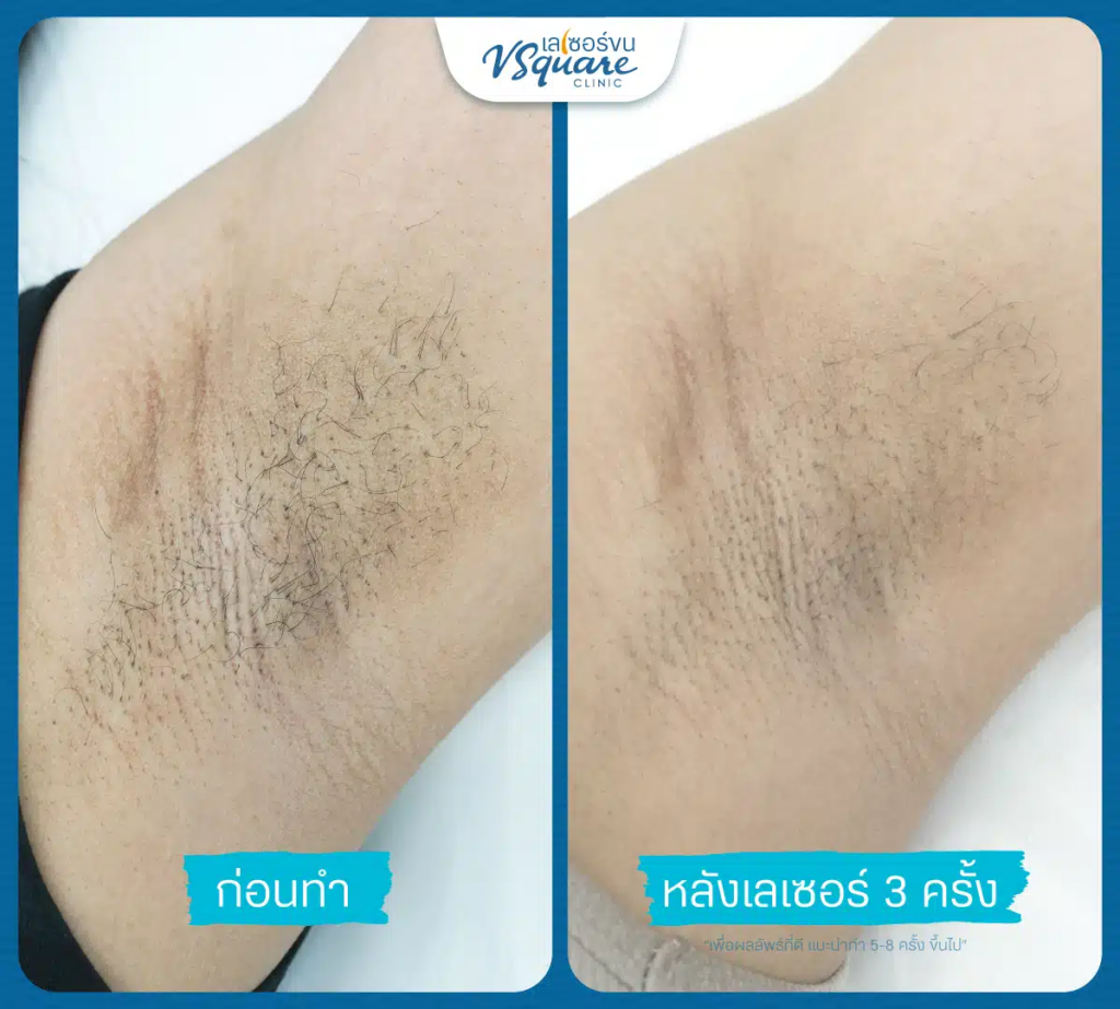 รีวิวเลเซอร์ขนที่ V Square Clinic