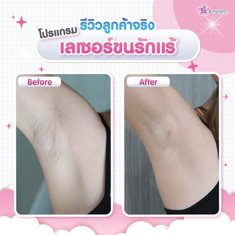 รีวิวเลเซอร์ขนที่ Gangnam Clinic
