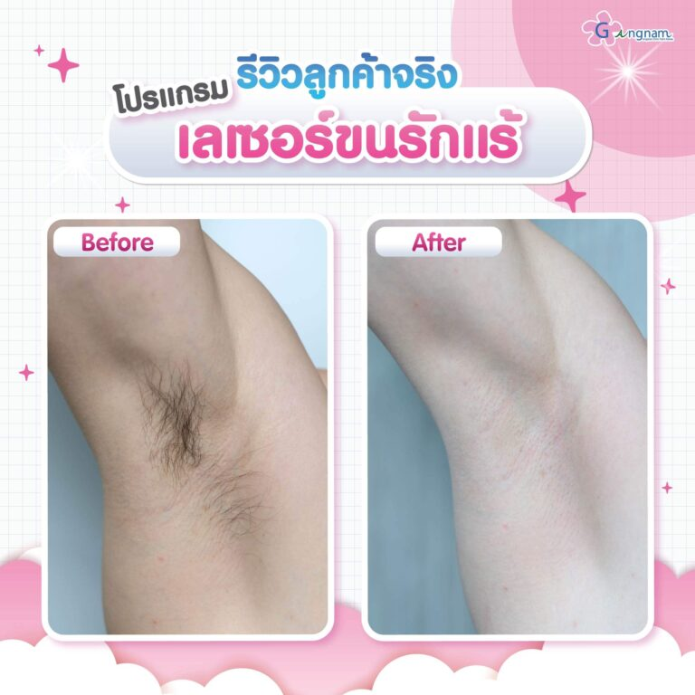 รีวิวเลเซอร์ขนที่ Gangnam Clinic