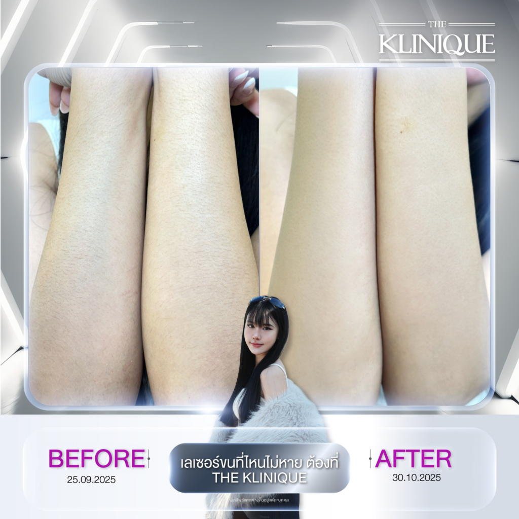 รีวิวเลเซอร์ขนที่ The Klinique