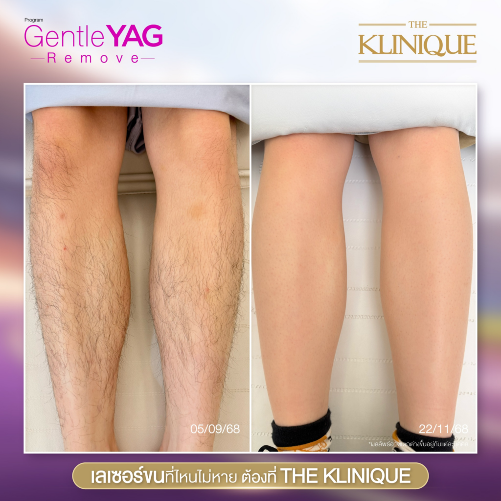 รีวิวเลเซอร์ขนที่ The Klinique