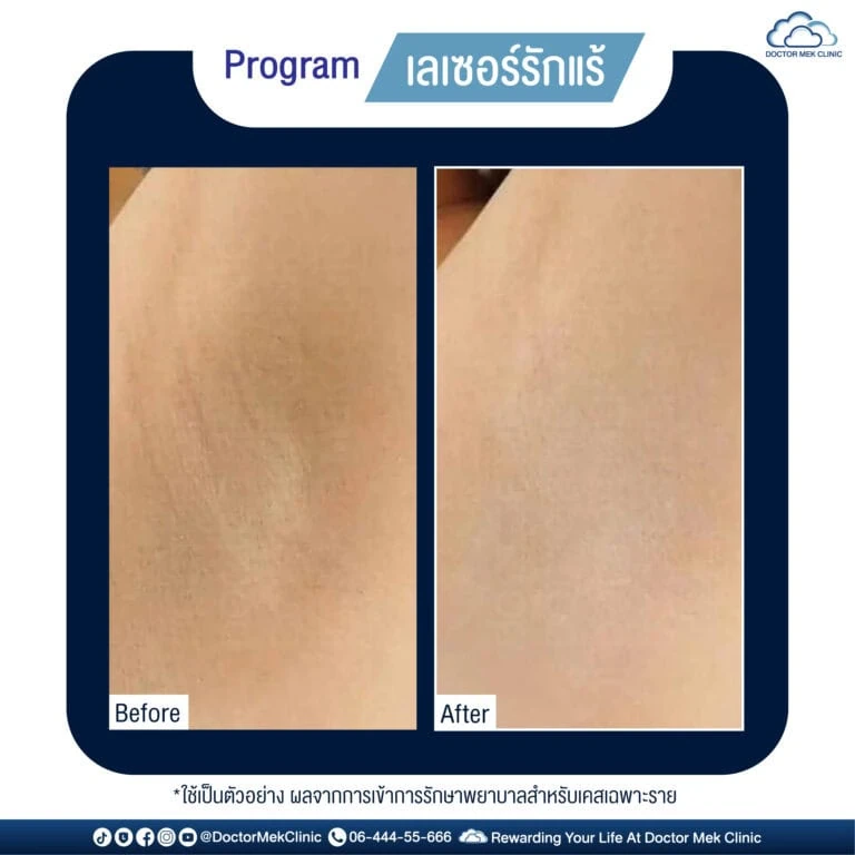 รีวิวเลเซอร์ขนที่ Doctor Mek Clinic