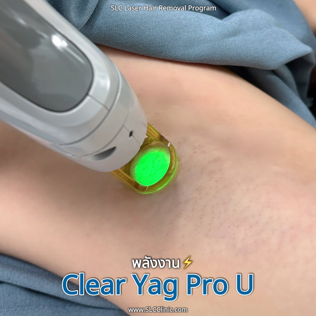 รีวิวเลเซอร์ขนที่ SLC Clinic