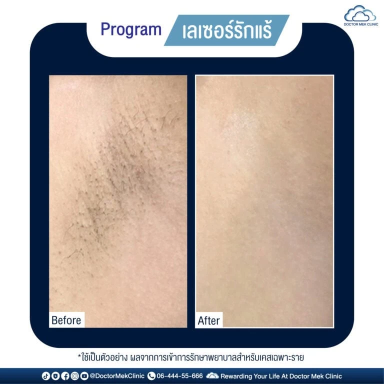 รีวิวเลเซอร์ขนที่ Doctor Mek Clinic