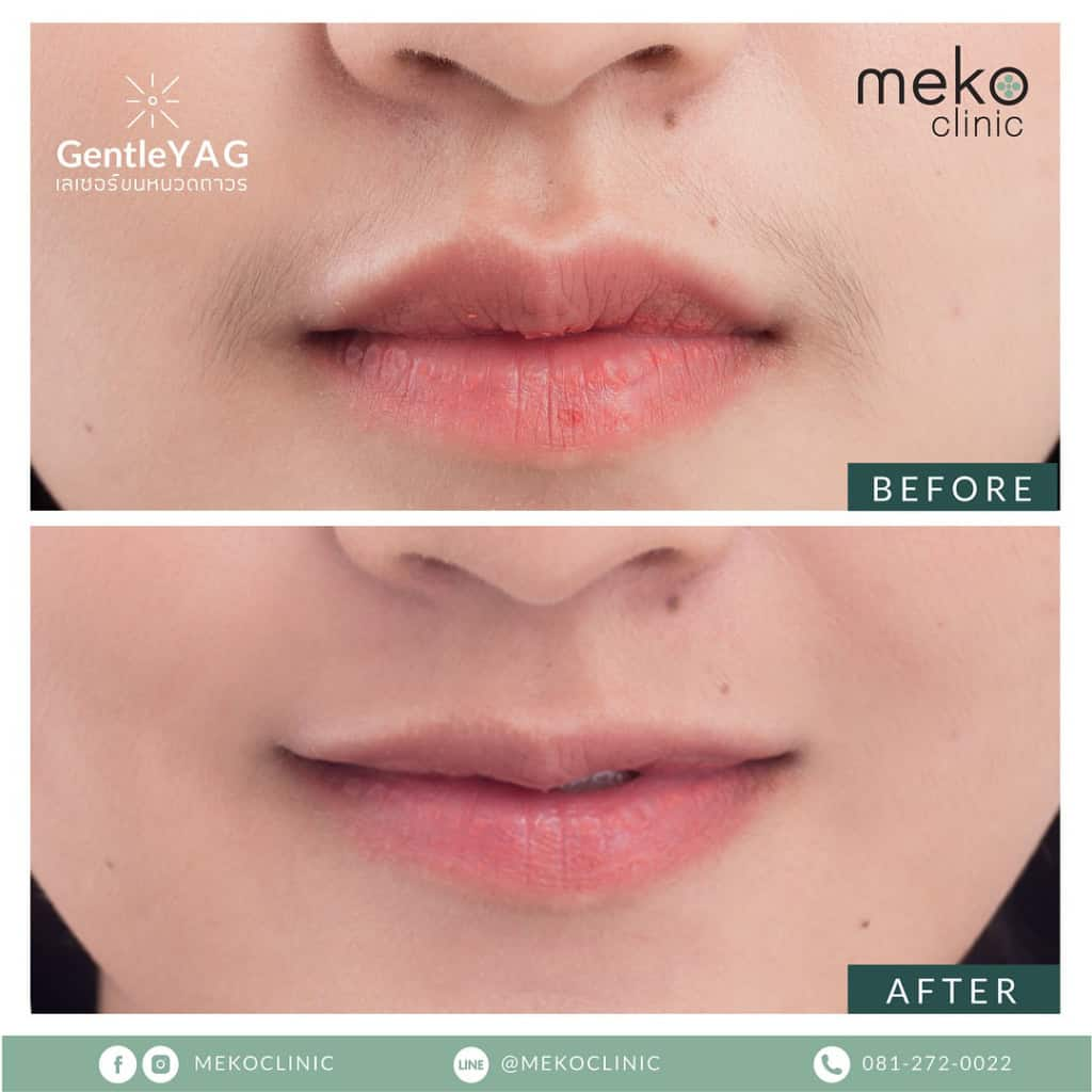 รีวิวเลเซอร์ขนที่ Meko Clinic