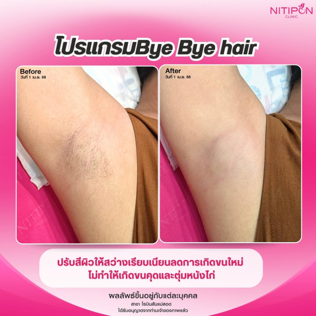 รีวิวเลเซอร์ขนที่ Nitipon Clinic