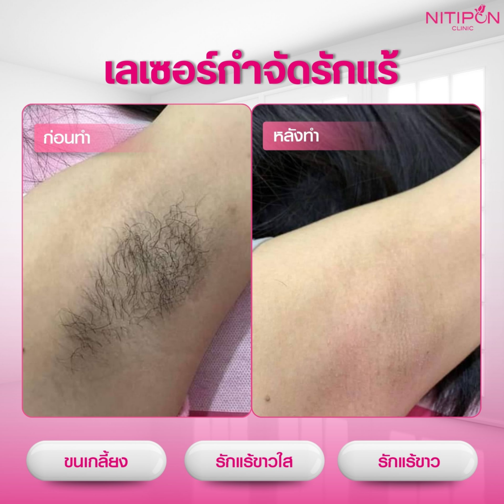 รีวิวเลเซอร์ขนที่ Nitipon Clinic