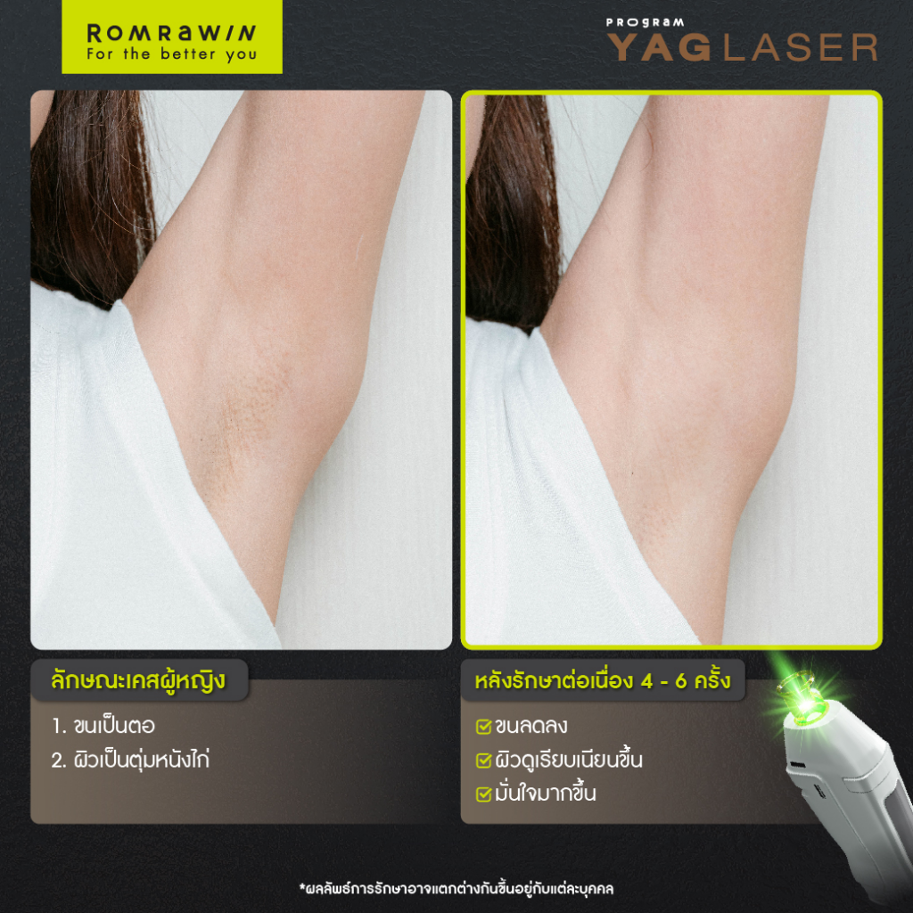 รีวิวเลเซอร์ขนที่ Romrawin Clinic