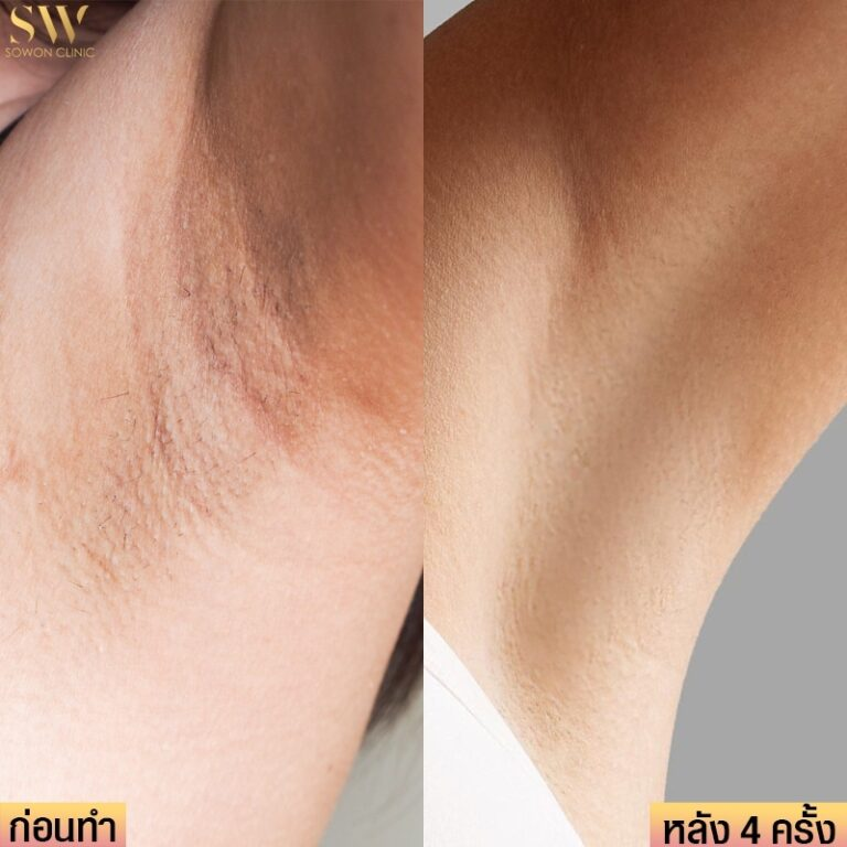 รีวิวเลเซอร์ขนที่ Sowon Clinic