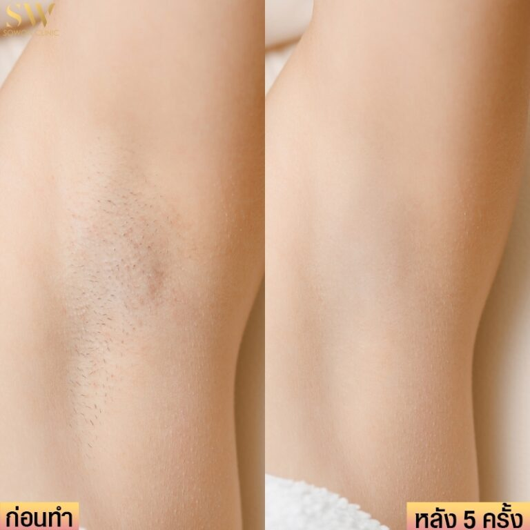 รีวิวเลเซอร์ขนที่ Sowon Clinic