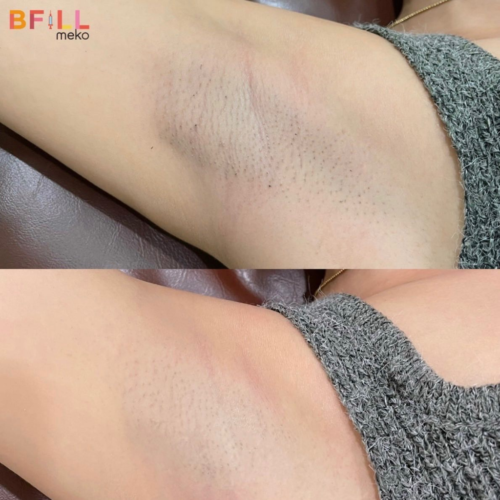 รีวิวเลเซอร์ขนที่ BFill Clinic