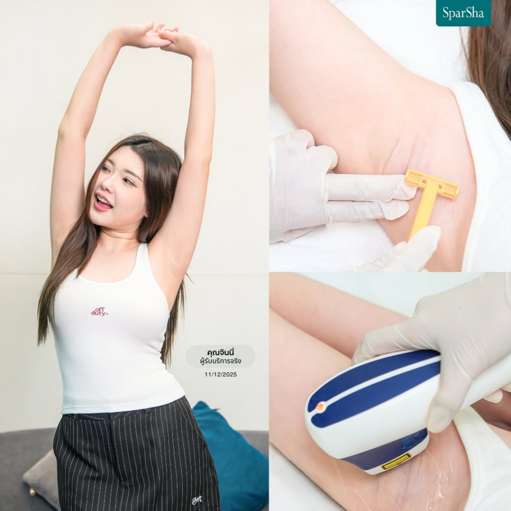 รีวิวเลเซอร์ขนที่ SparSha