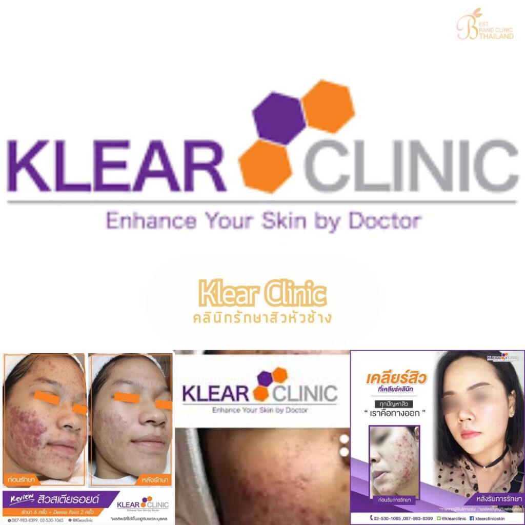 รักษาสิวหัวช้างที่ Klear Clinic