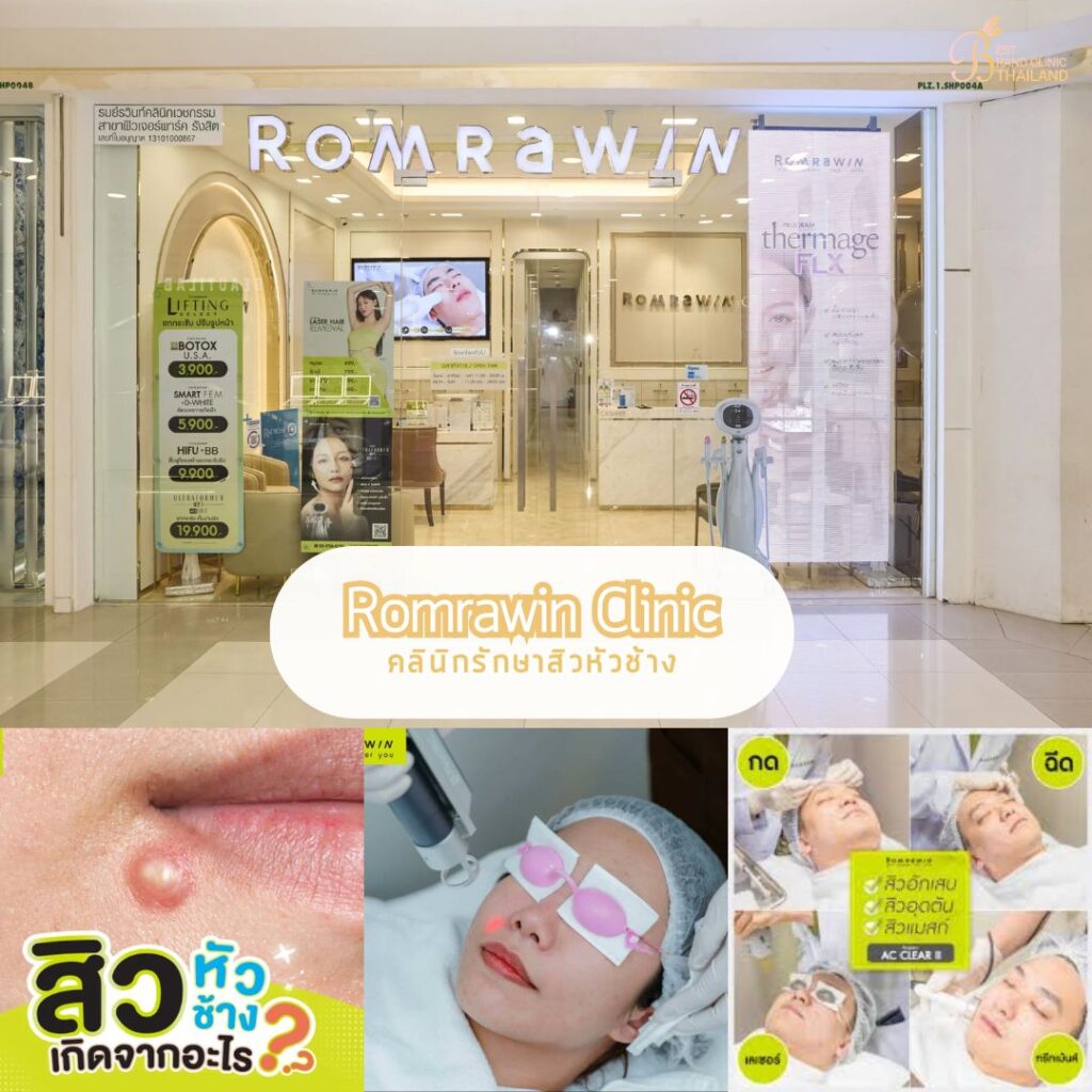 รักษาสิวหัวช้างที่ Romrawin Clinic